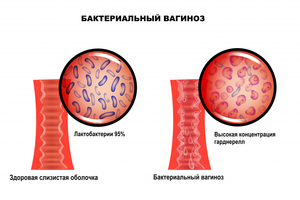 Вагиноз.jpg