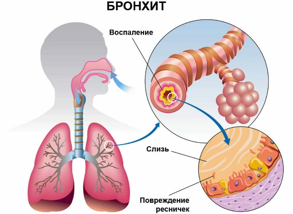 Moraxella catarrhalis (Moraxella catarrhalis) в носу у ребенка. Что это, норма, как лечить